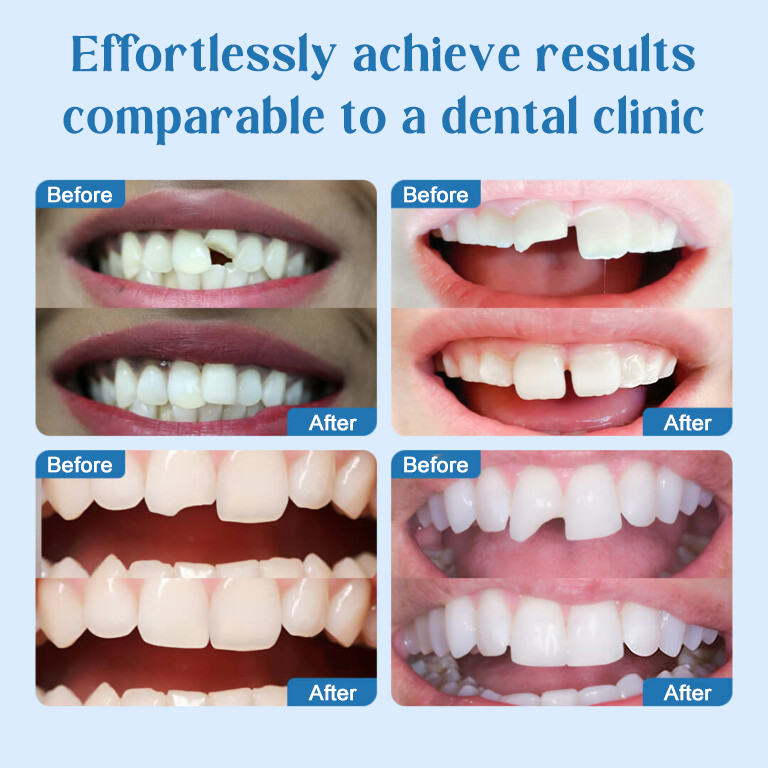🦷Stop Hiding Your Teeth — Get a Perfect Smile in Minutes, No Dentist Needed🏠✨